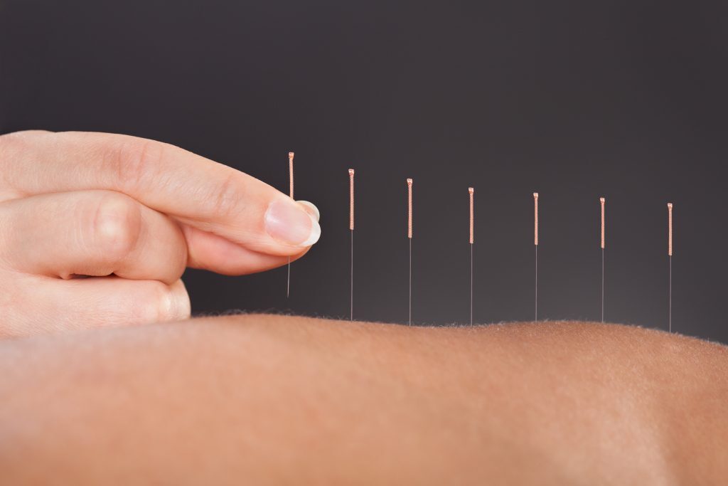 Healing-Headaches-with-Acupuncture